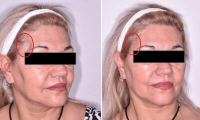 lipotransferencia
