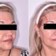 lipotransferencia